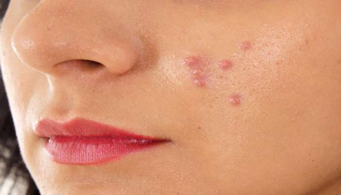 Pimple: ಮೊಡವೆಗಳನ್ನು ಬುಡಸಮೇತ ಕಿತ್ತುಹಾಕಲು ಈ 3 ಆರೋಗ್ಯಕರ ಪಾನೀಯಗಳು ಸೇವಿಸಿ