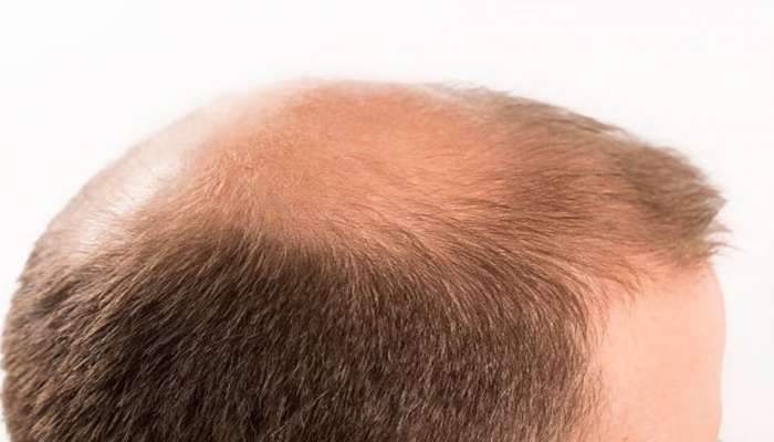 Hair loss treatment: ಪ್ರತಿದಿನ ಆಹಾರದಲ್ಲಿ ಬಳಸುವ ಈ ಪದಾರ್ಥವೇ ಬೋಳು ತಲೆಗೆ ಕಾರಣವಾಗುತ್ತಿದೆ! title=