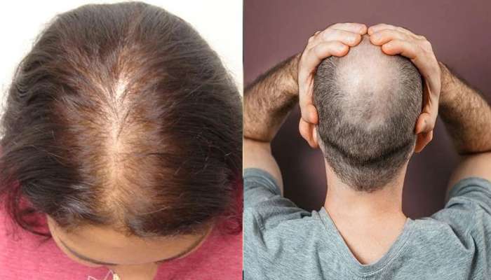 Easy solution for hair fall problem | ಹೇರ್ ಫಾಲ್ ಸಮಸ್ಯೆಗೆ ಸುಲಭ ಪರಿಹಾರ  Lifestyle News in Kannada