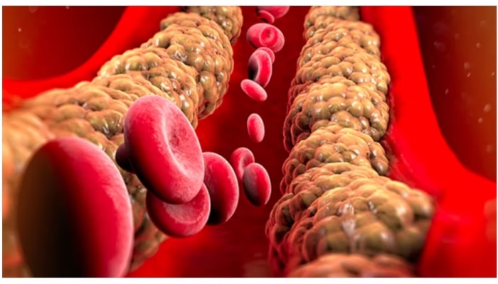 Cholesterol: ಹೈ ಕೊಲೆಸ್ಟ್ರಾಲ್ ನಿಂದ ಮುಕ್ತಿ ಪಡೆಯಲು ನಿತ್ಯ ಈ ಜ್ಯೂಸ್ ಸೇವಿಸಿ