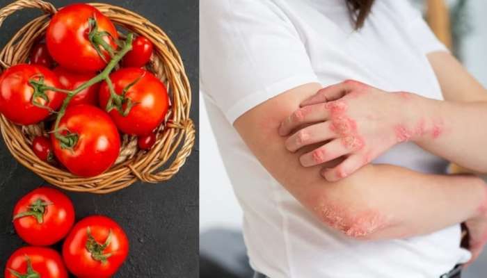 Tomato Side Effects: ಅತಿಯಾದ ಟೊಮೊಟೊ ಸೇವನೆಯಿಂದ ಕಾಡುತ್ತೆ ಈ ಆರೋಗ್ಯ ಸಮಸ್ಯೆ.!