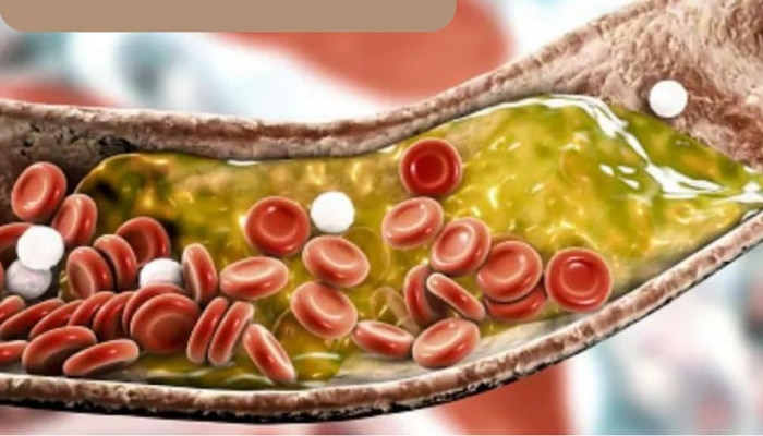 High Cholesterol: ಕೊಲೆಸ್ಟ್ರಾಲ್ ರೋಗಿಗಳು ಅಪ್ಪಿತಪ್ಪಿಯೂ ಈ ಆಹಾರ ಸೇವಿಸಬಾರದು!