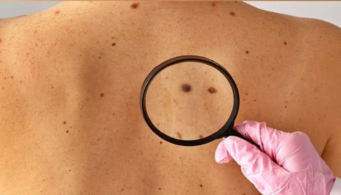Skin cancer: ದೇಹದ ಮೇಲಿನ ಮಚ್ಚೆ ನೀಡುತ್ತೆ ಚರ್ಮದ ಕ್ಯಾನ್ಸರ್‌ನ ಸೂಚನೆ   title=