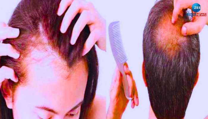 Hair Fall: ಚಿಕ್ಕ ವಯಸ್ಸಿನಲ್ಲೇ ಕೂದಲುದುರಲು ಈ ಪೋಷಕಾಂಶದ ಕೊರತೆಯೇ ಪ್ರಮುಖ ಕಾರಣ 