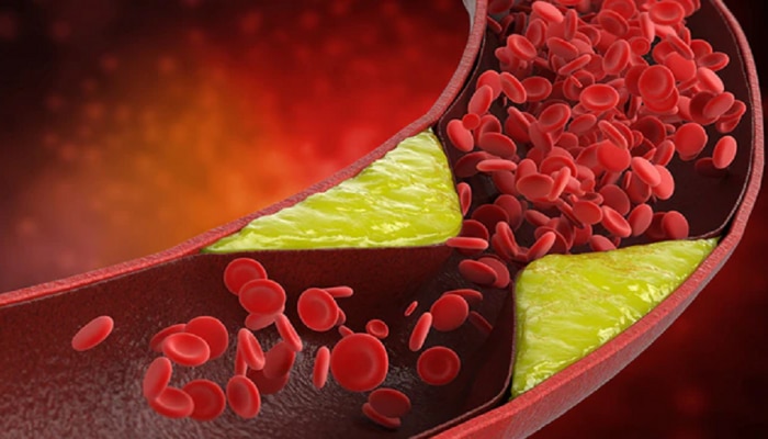 Bad cholesterol: ಕೆಟ್ಟ ಕೊಲೆಸ್ಟ್ರಾಲ್ ನಿಯಂತ್ರಣಕ್ಕೆ ಈ 5 ಆಹಾರ ಸೇವಿಸಿರಿ   