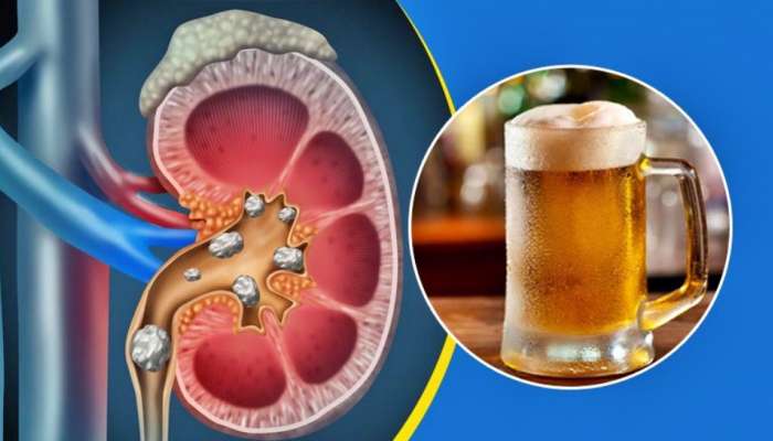 Health Benefits of Beer for Kidneys : ಬಿಯರ್ ಕುಡಿಯುವುದರಿಂದ ಕಿಡ್ನಿ ಸ್ಟೋನ್ ಹೋಗುತ್ತವೆ..! ಇದು ನಿಜವೇ? title=