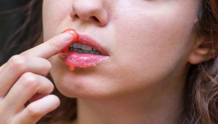 Remedies to get rid of black lips : ಕಪ್ಪಾದ ತುಟಿಗಳಿಗೆ ಮತ್ತೆ ಗುಲಾಬಿ ಬಣ್ಣ ನೀಡುತ್ತದೆ ನಿಂಬೆ ಮತ್ತು ಈ ವಸ್ತುವಿನ ಮಿಶ್ರಣ 