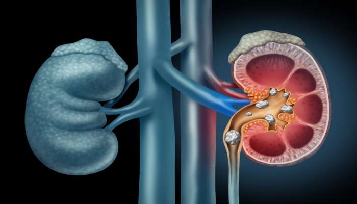 Kidney Health :ಅಡುಗೆಗೆ ಬಳಸುವ ಈ ಮೂರು ವಸ್ತುಗಳೇ ಕಿಡ್ನಿ ಸ್ಟೋನ್ ಗೆ ಕಾರಣವಾಗುವುದು ! title=