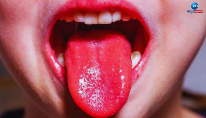 Mouth Ulcer: ಬಾಯಿ ಹುಣ್ಣು ಸಮಸ್ಯೆಗೆ ನಿಮ್ಮ ಅಡುಗೆ ಮನೆಯಲ್ಲಿಯೇ ಇದೆ ಪರಿಹಾರ 