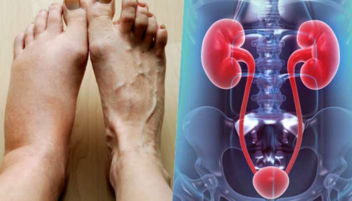 Kidney Health: ಕಿಡ್ನಿ ವೈಫಲ್ಯದ ಮುನ್ಸೂಚನೆ ಪಾದಗಳಲ್ಲಿ ಕಾಣುವ ಈ ಬದಲಾವಣೆ !!