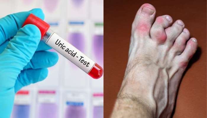 Juice For Uric Acid Zee News Kannada juice-for-uric-acid-zee-news-kannada