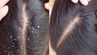 Dandruff: ತಲೆ ಹೊಟ್ಟಿನಿಂದ ಮುಕ್ತಿ ಪಡೆಯಲು ಈ ಸಿಂಪಲ್‌ ಸಲಹೆಗಳನ್ನು ಪಾಲಿಸಿ