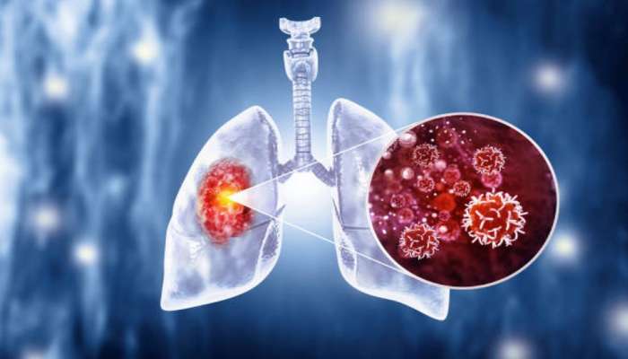 Lung Cancer : ಸಿಗರೇಟ್‌ನಿಂದ ಮಾತ್ರವಲ್ಲ... ಈ ಕಾರಣದಿಂದಲೂ ಬರಬಹುದು ಮಾರಕ ಶ್ವಾಸಕೋಶದ ಕ್ಯಾನ್ಸರ್‌ ! title=