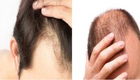 Hair care Tips: ಪುರುಷರ ಬೊಕ್ಕ ತಲೆಗೆ ಕಾರಣವೇನು? ಇಲ್ಲಿದೆ ಸರಳ ಉತ್ತರ 