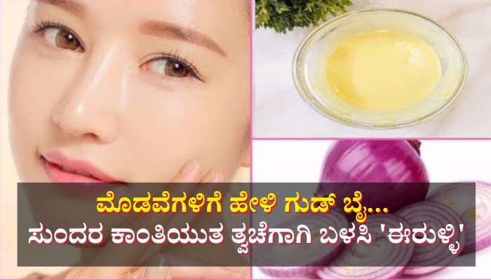 ಮೊಡವೆಗಳಿಗೆ ಗುಡ್ ಬೈ ಹೇಳಿ... ಕ್ಲಿಯರ್ ಸ್ಕಿನ್ ಪಡೆಯಲು ಅತ್ಯುತ್ತಮ ಮದ್ದು 'ಈರುಳ್ಳಿ ರಸ'  