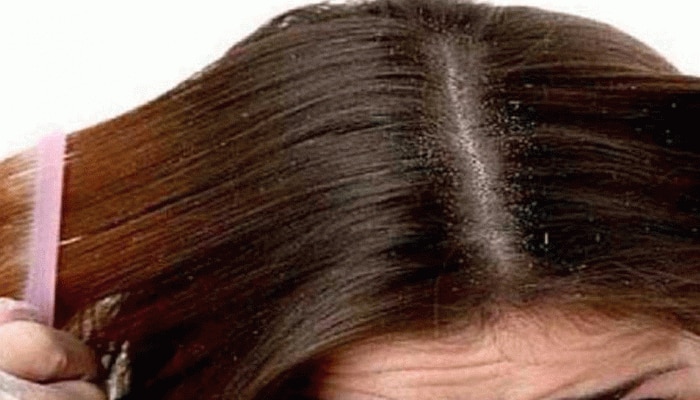 Hair Care Tips: ಡ್ಯಾಂಡ್ರಫ್ ಏಕೆ ಬರುತ್ತದೆ? ತಲೆಹೊಟ್ಟು ನಿವಾರಣೆಗೆ  ಇಲ್ಲಿದೆ ಸುಲಭ ಮಾರ್ಗ