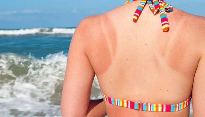 Skin Tanning Removing Tips: ಚರ್ಮದ ಟ್ಯಾನಿಂಗ್ ನಿವಾರಿಸಲು ಸಿಂಪಲ್ ಮನೆಮದ್ದು 